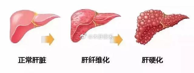 肝硬化最新治疗方法概述