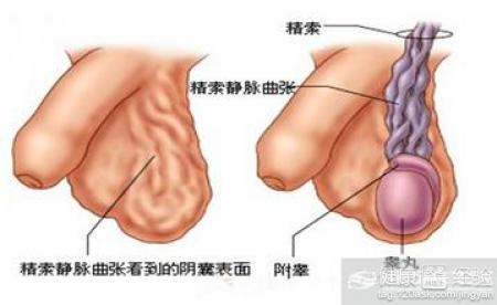 最新静脉曲张治疗方法的研究进展概览